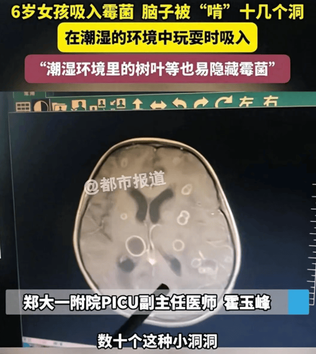 皇冠信用网代理
_6岁女童发烧17天皇冠信用网代理
,脑子竟被“啃”出十几个洞!“元凶”家中很常见!