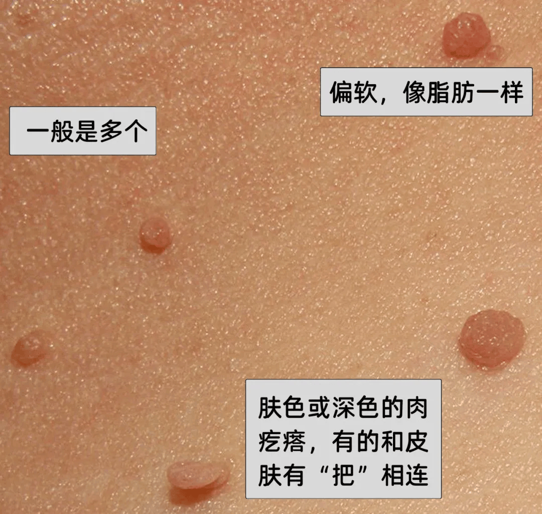 皇冠信用網在哪里开通_脖子上长出的小肉粒皇冠信用網在哪里开通，能揪吗？